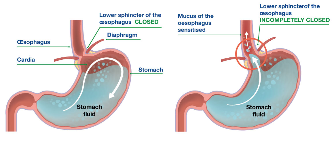 stomach-acid paradoxul acidului gastric